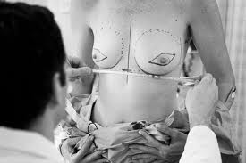 Breast Reconstructive Plastic Surgery in Bangkok, Phuket Thailand